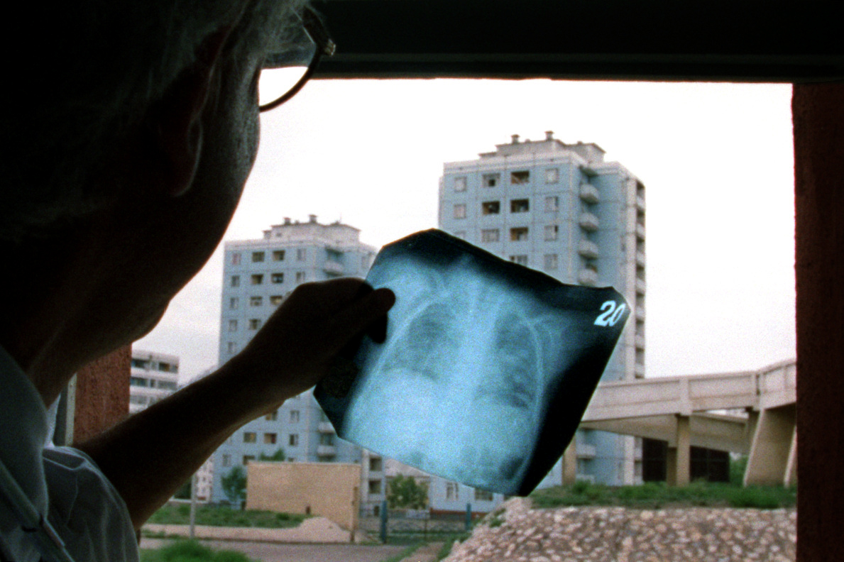 Dr. Larry Ross, associate professor of clinical pediatrics at USC and Children's Hospital of Los Angeles, uses a window to examine xrays of a child's lungs. The country has mostly rudimentary medical equipment. ©Gail Fisher Los Angeles Times