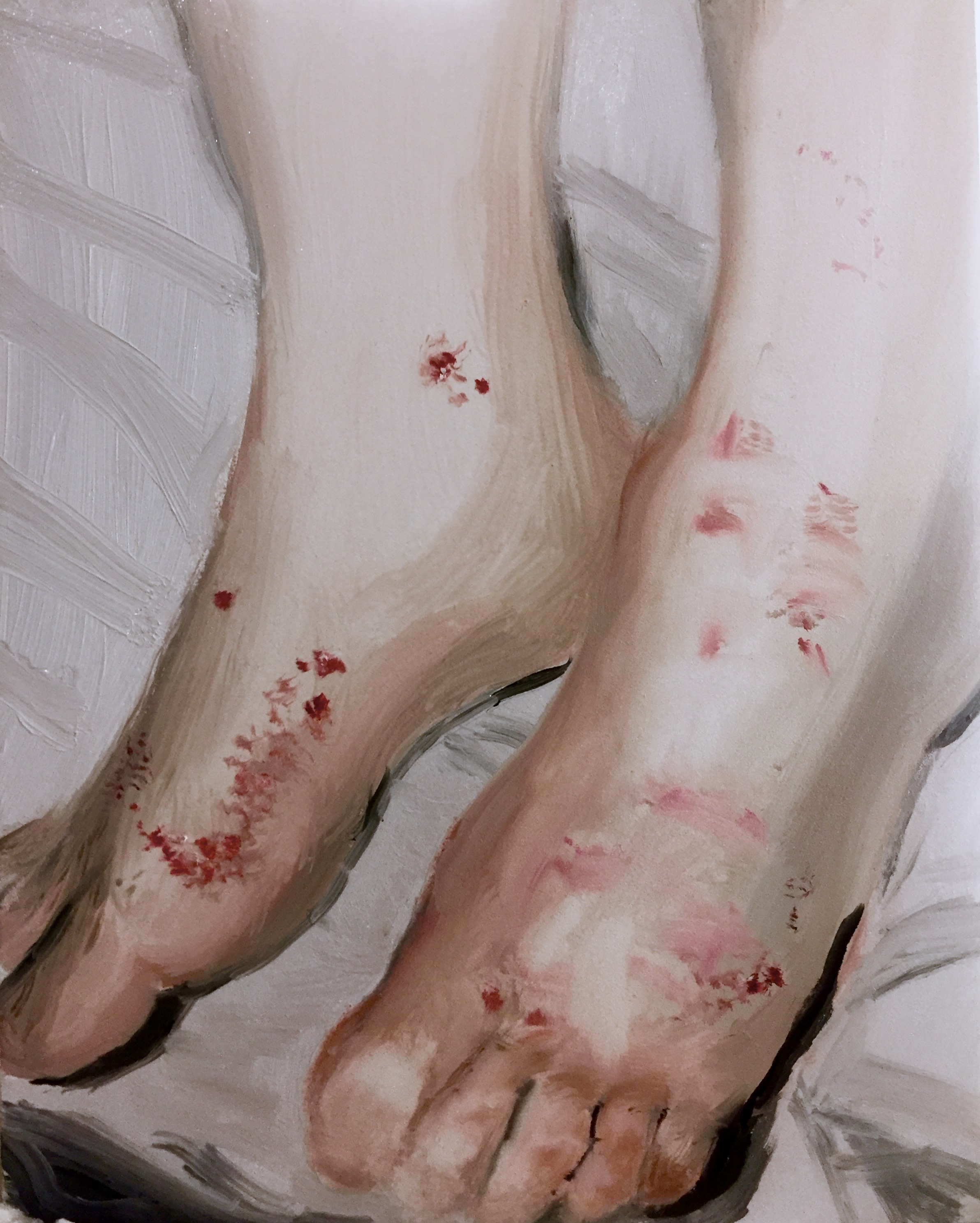 "Purpura due to Nafcillin"