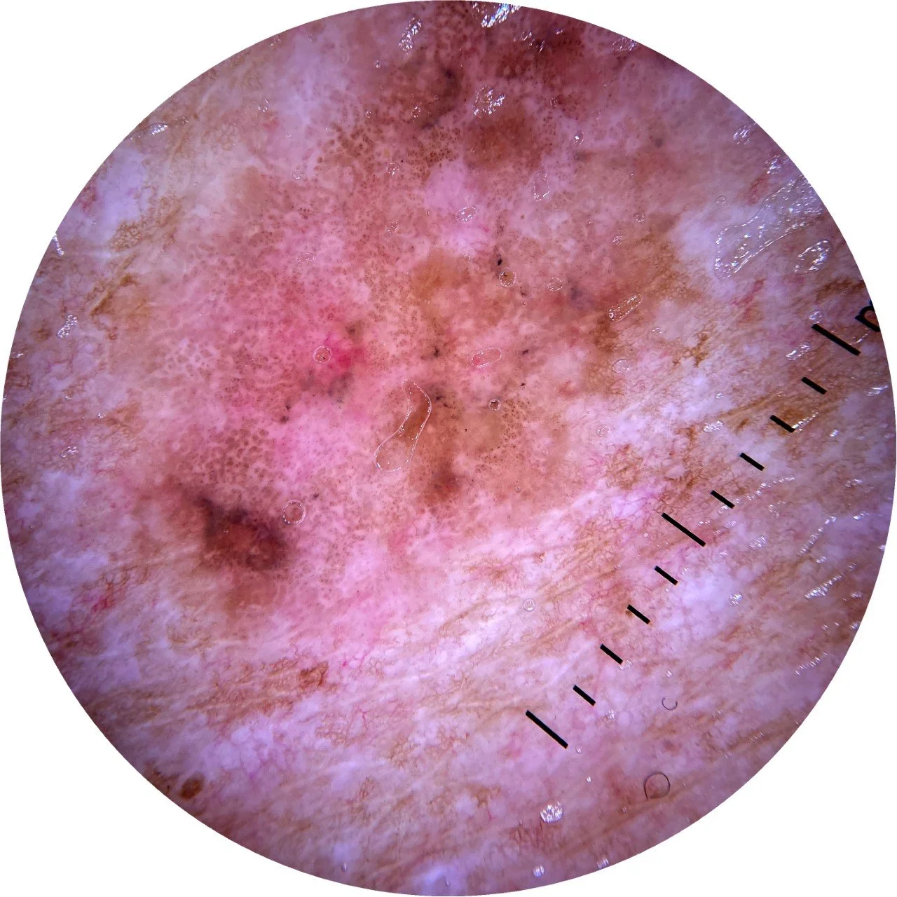 thumbnail_Melanoma Back - Dermoscopic view .jpg