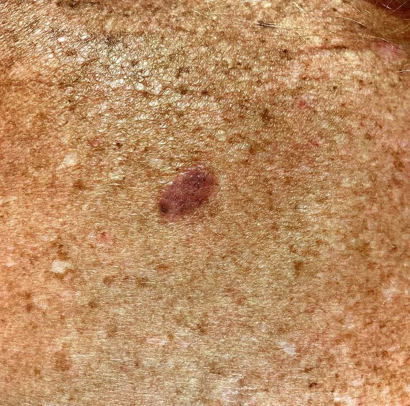 Melanoma on the back .jpg