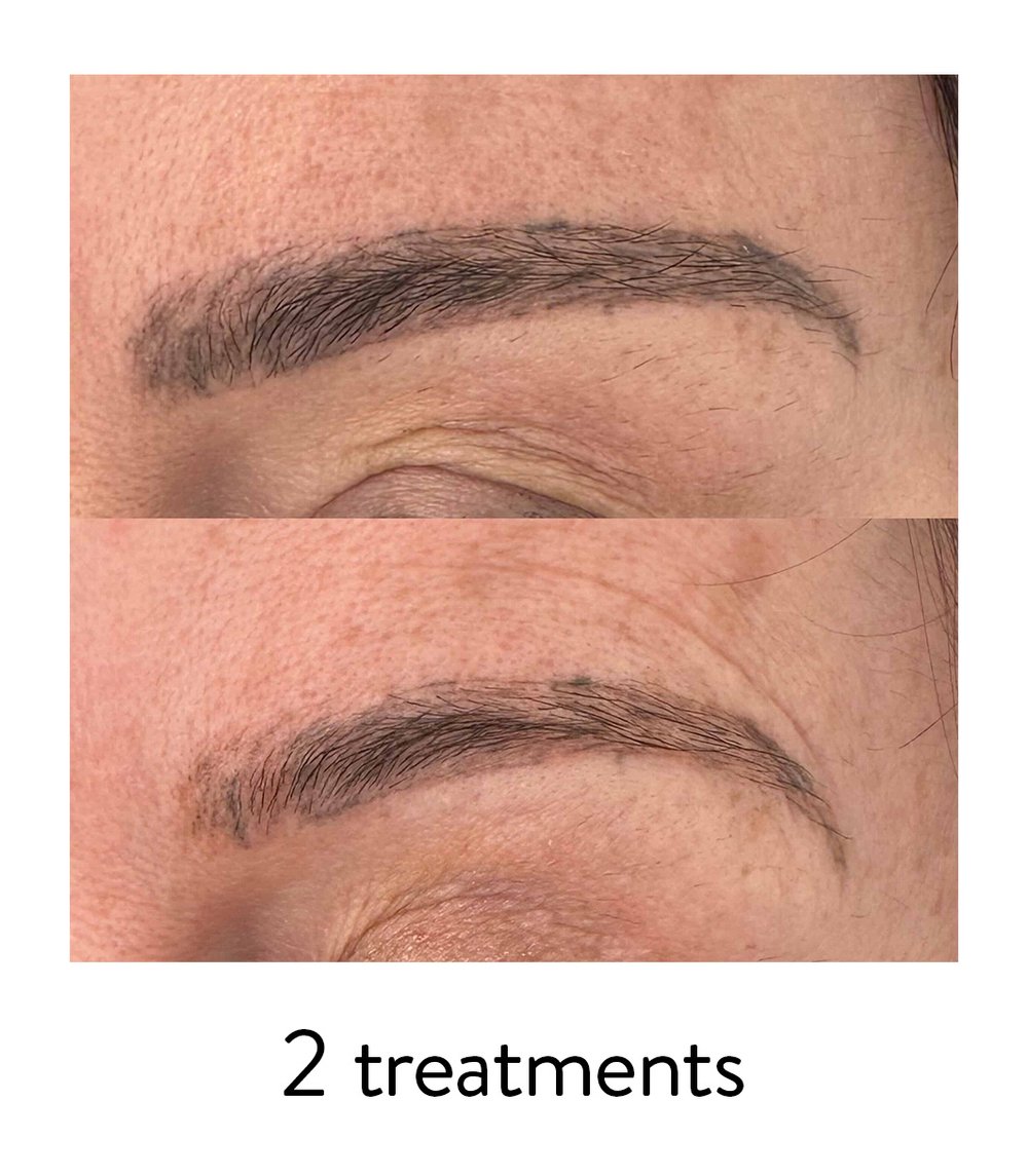 Laser Studio brow tattoo removal 1-.jpg