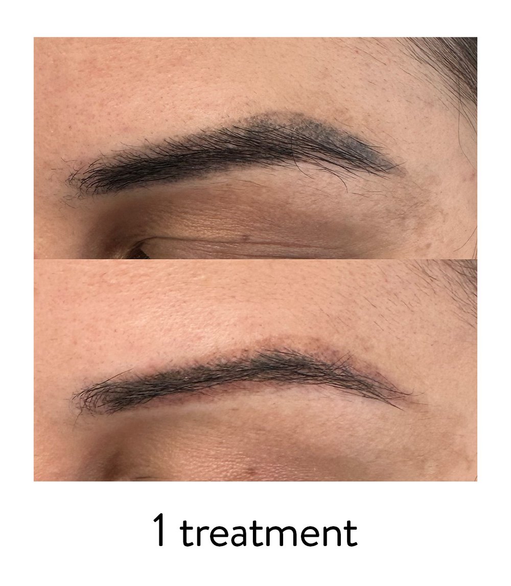 Laser Studio eyebrow tattoo removal.jpg