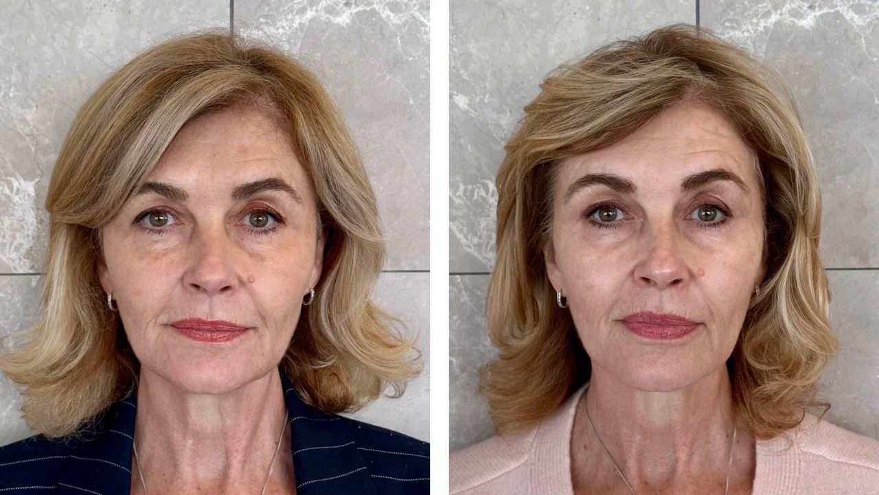 Laser pigment removal