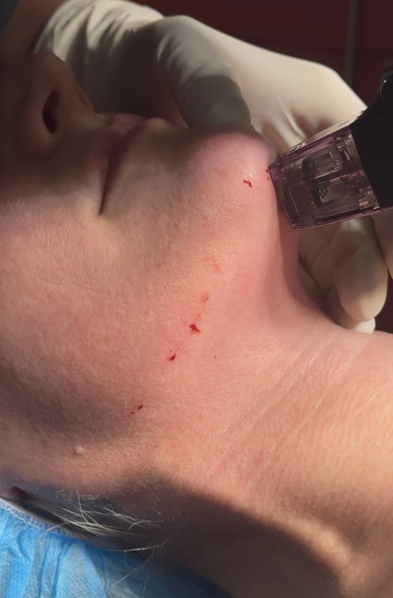 Morpheus8 - the treatment redefining skin rejuvenation