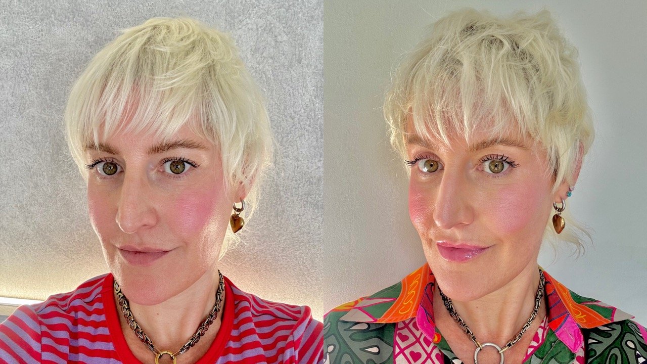 Everything You Need to Know About Lip Filler 