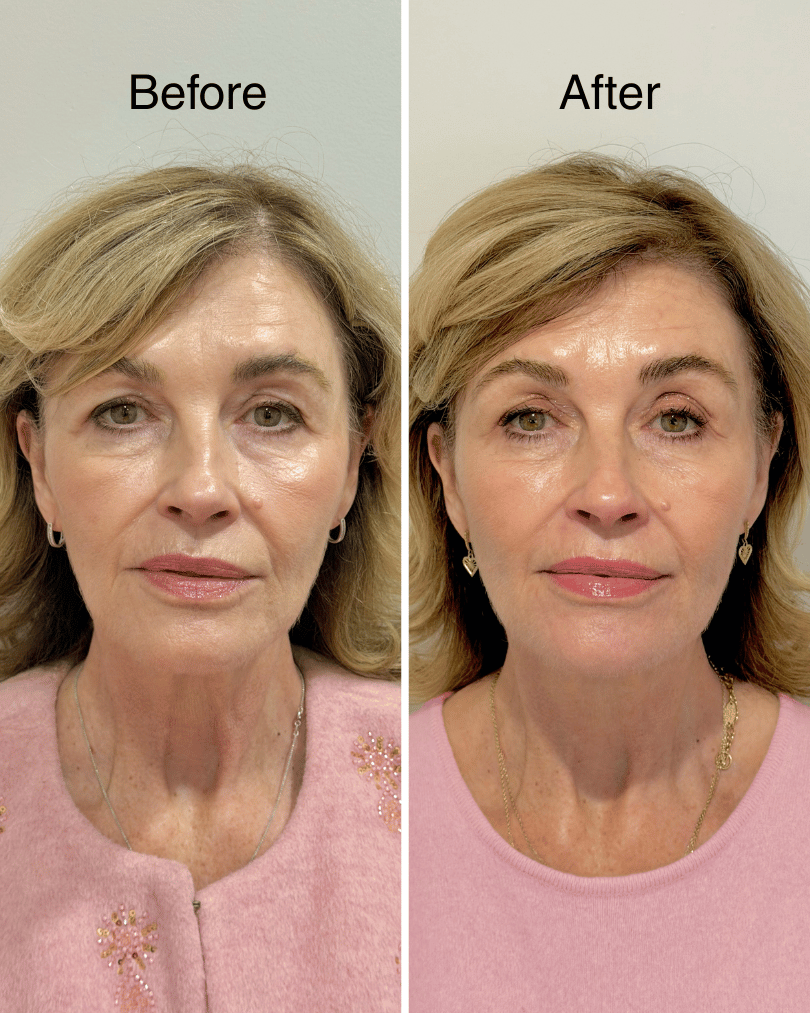 HArmonyCa: The Hybrid Injectable That Lifts, Firms and Stimulates Collagen