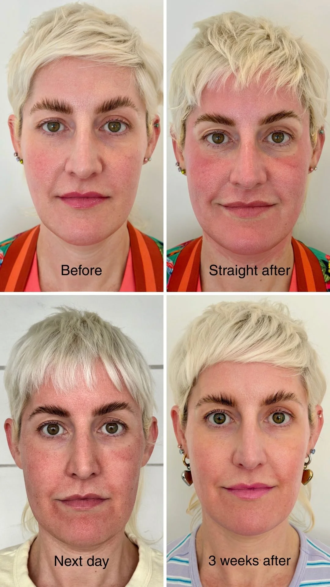 I Tried BBL + MOXI: Here’s What Happened to My Skin