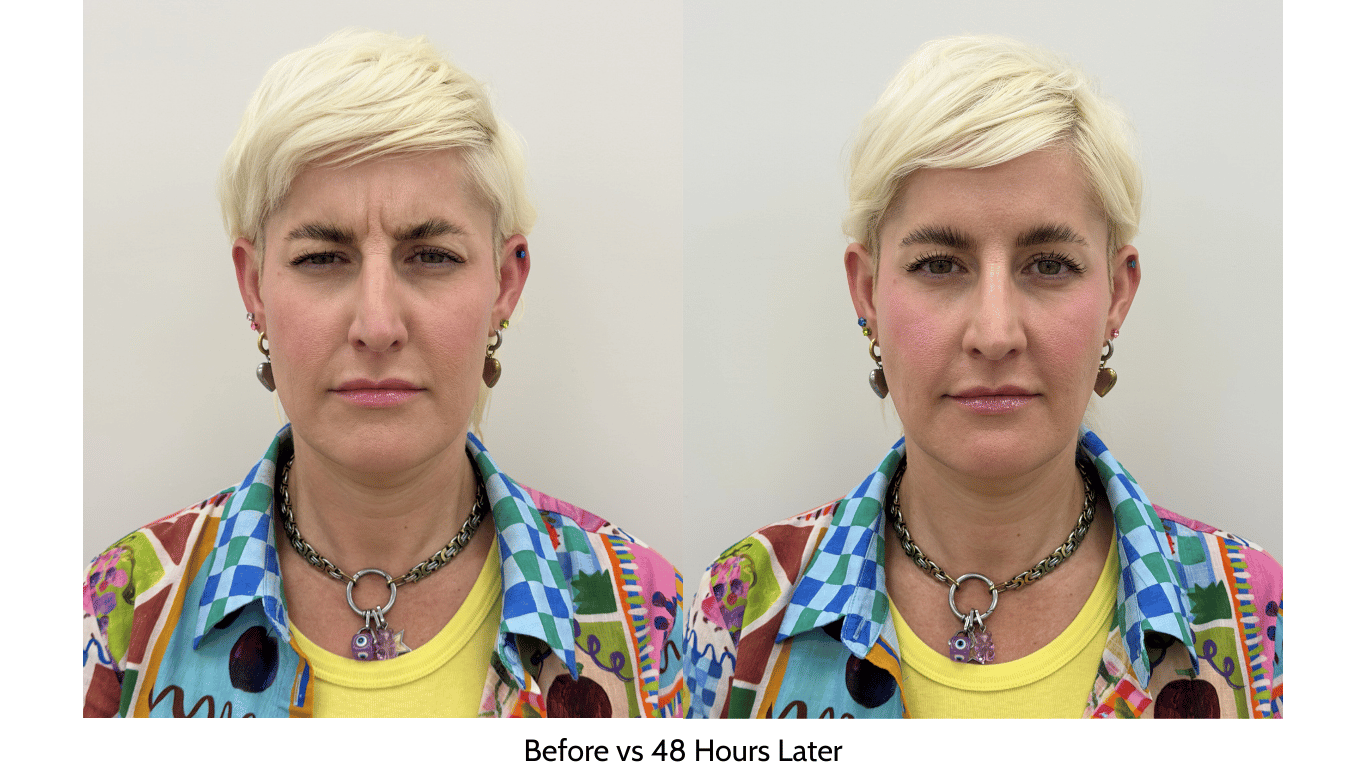 What is Relfydess injectable treatment