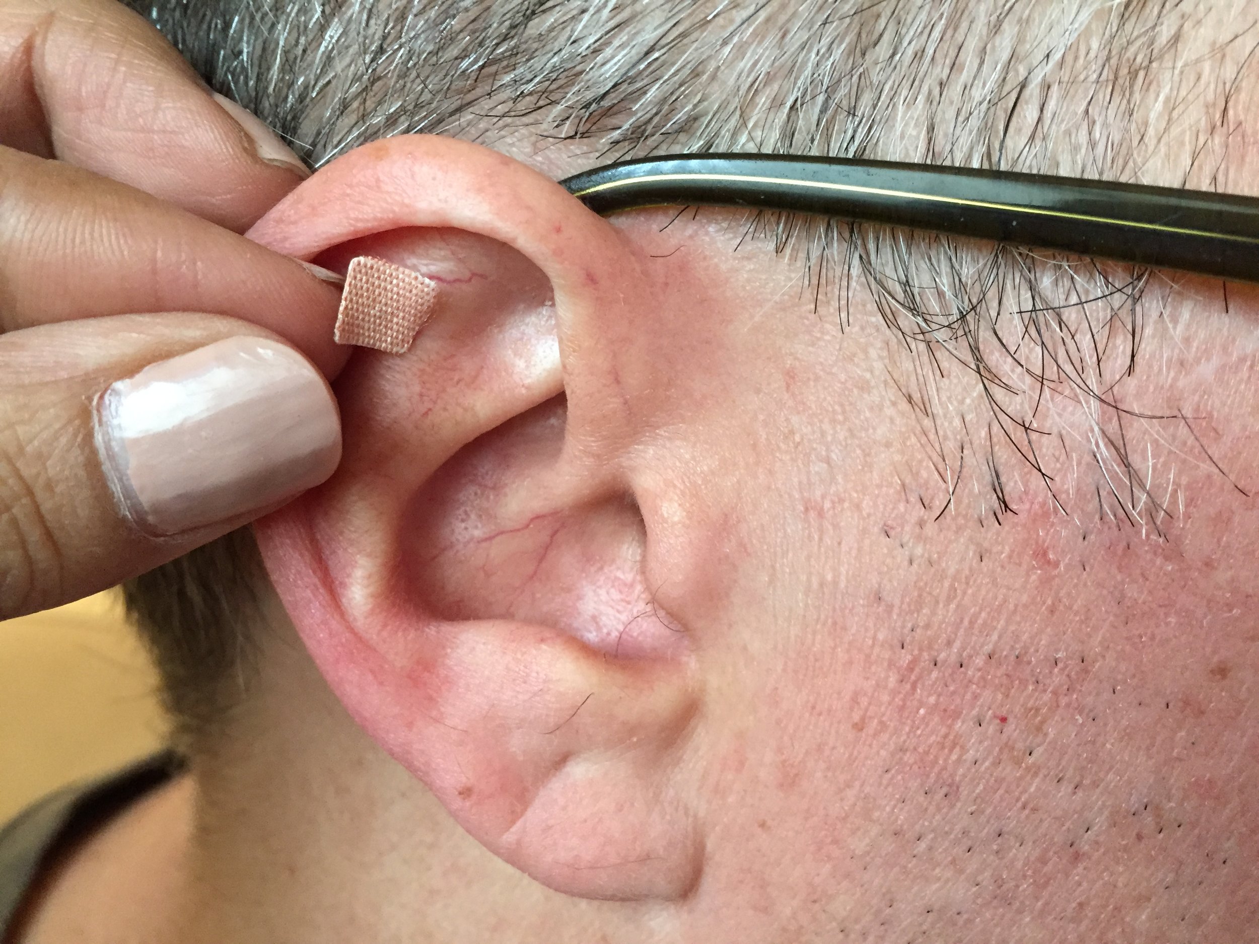 Vaccaria seeds can be applied to any point on the body, but because they are commonly applied to one of the hundreds of points on the ear, they are often referred to as earseeds.