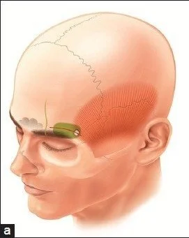 How did Scoville access Patient HM's medial temporal lobe?