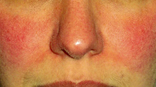 Living with and managing rosacea 
