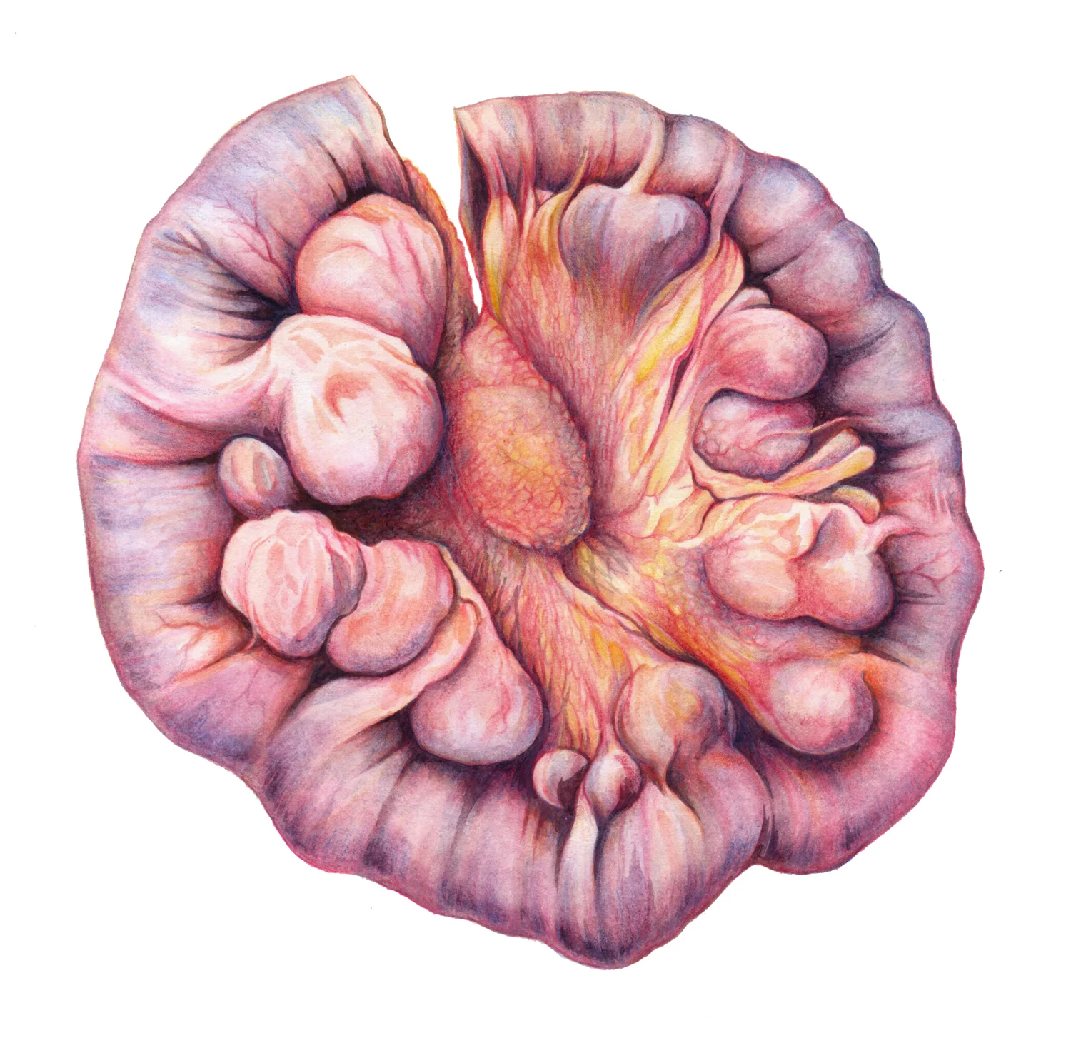 Jejunal diverticulosis Media: watercolour