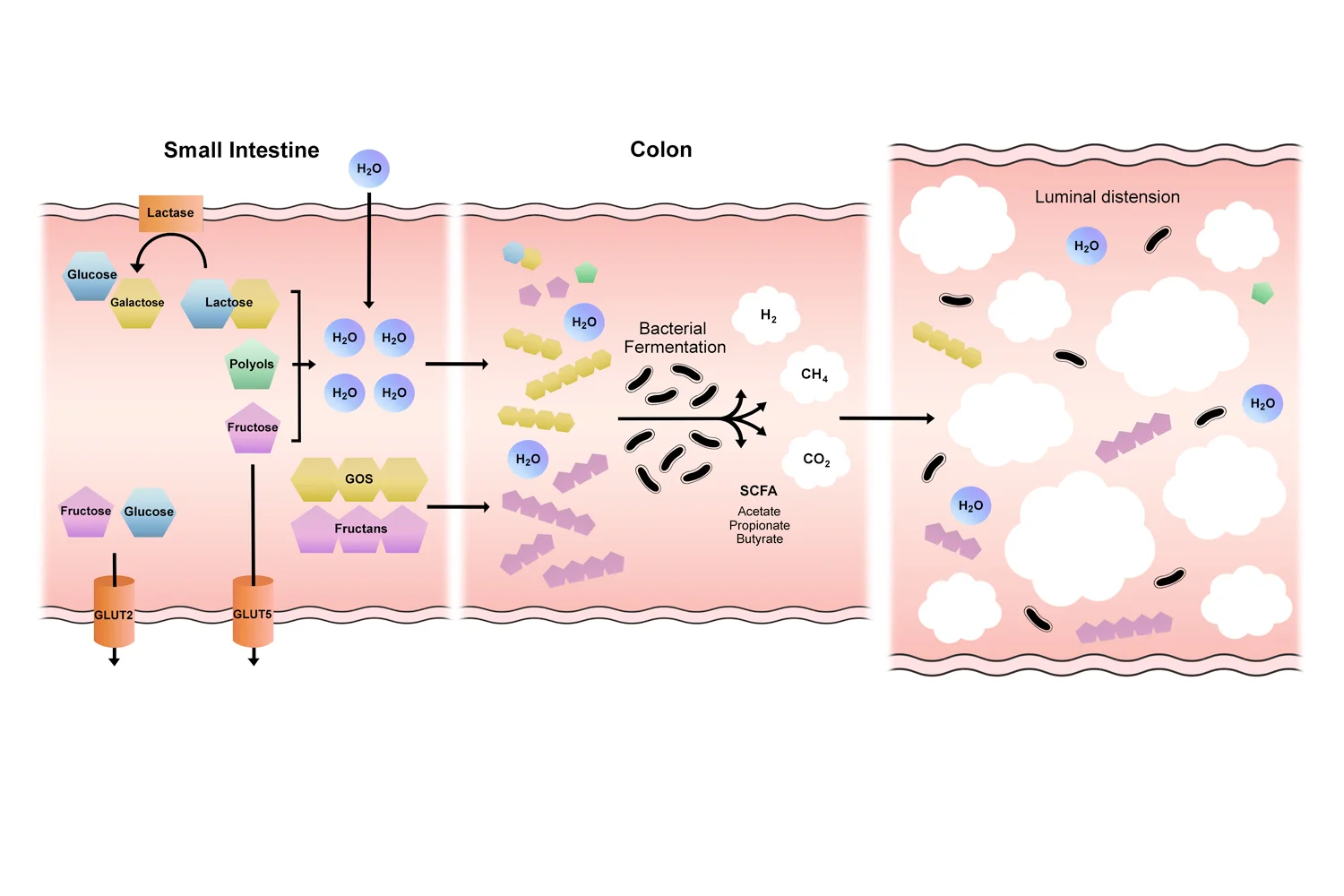 Mechanisms of the effects of fermentable oligosaccharides, disaccharides, monosaccharides and polyols on GI function Publication: Staudacher HM, Whelan K .The low FODMAP diet: recent advances in understanding its mechanisms and efficacy in IBS. Gut 2017;66:1517-1527 Client: Professor Kevin Whelan, Professor of Dietetics, King’s College London Media: Adobe Photoshop