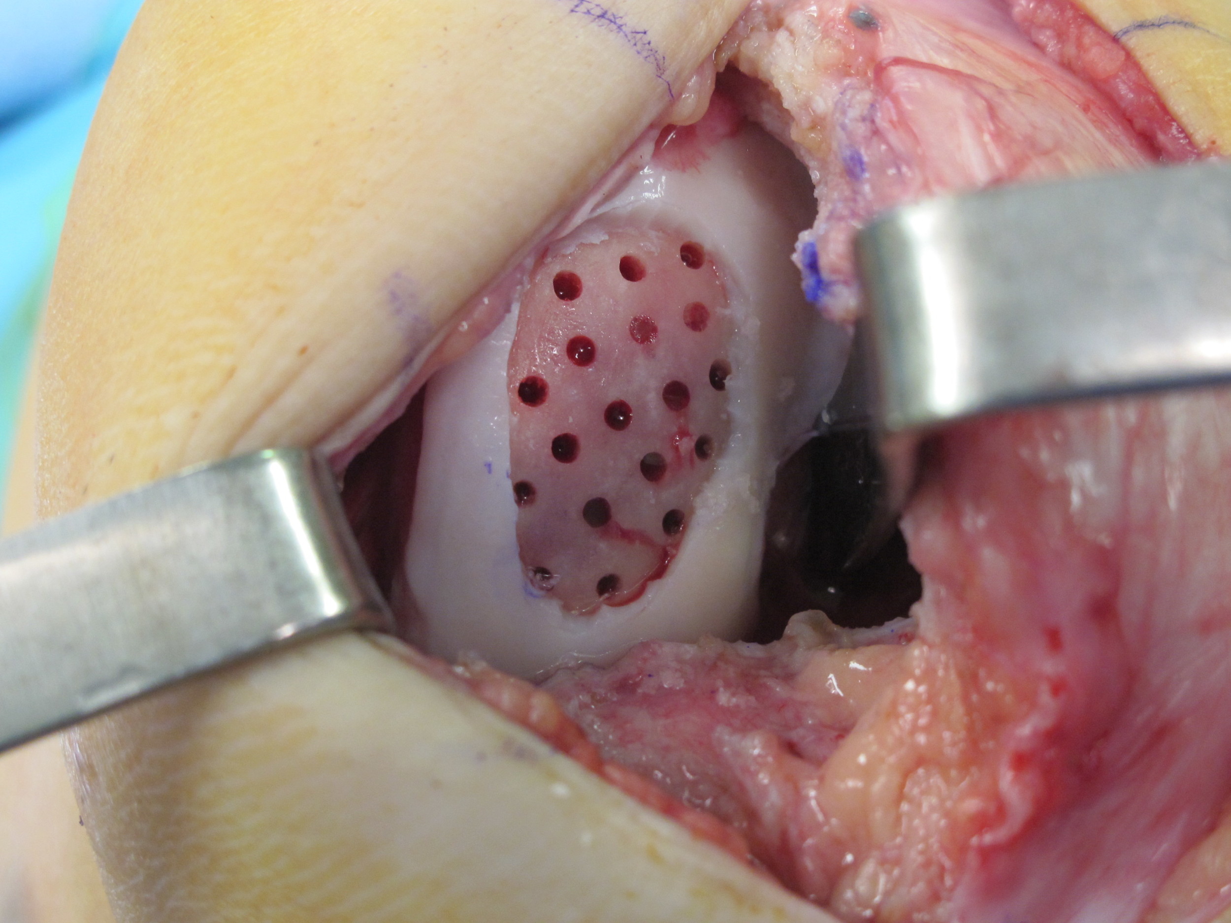 Cartilage defect after subchondral drilling