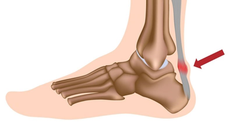 7 Heel Spur Myths and Facts | Heel That Pain