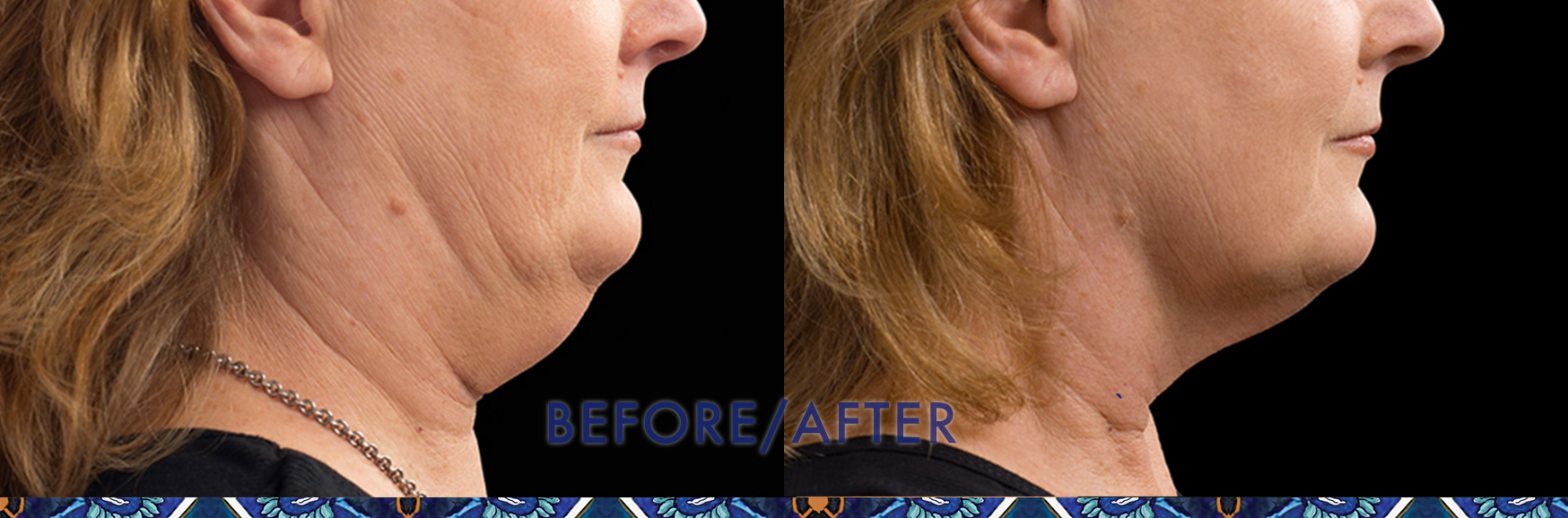 How to get rid of a double chin with CoolSculpting