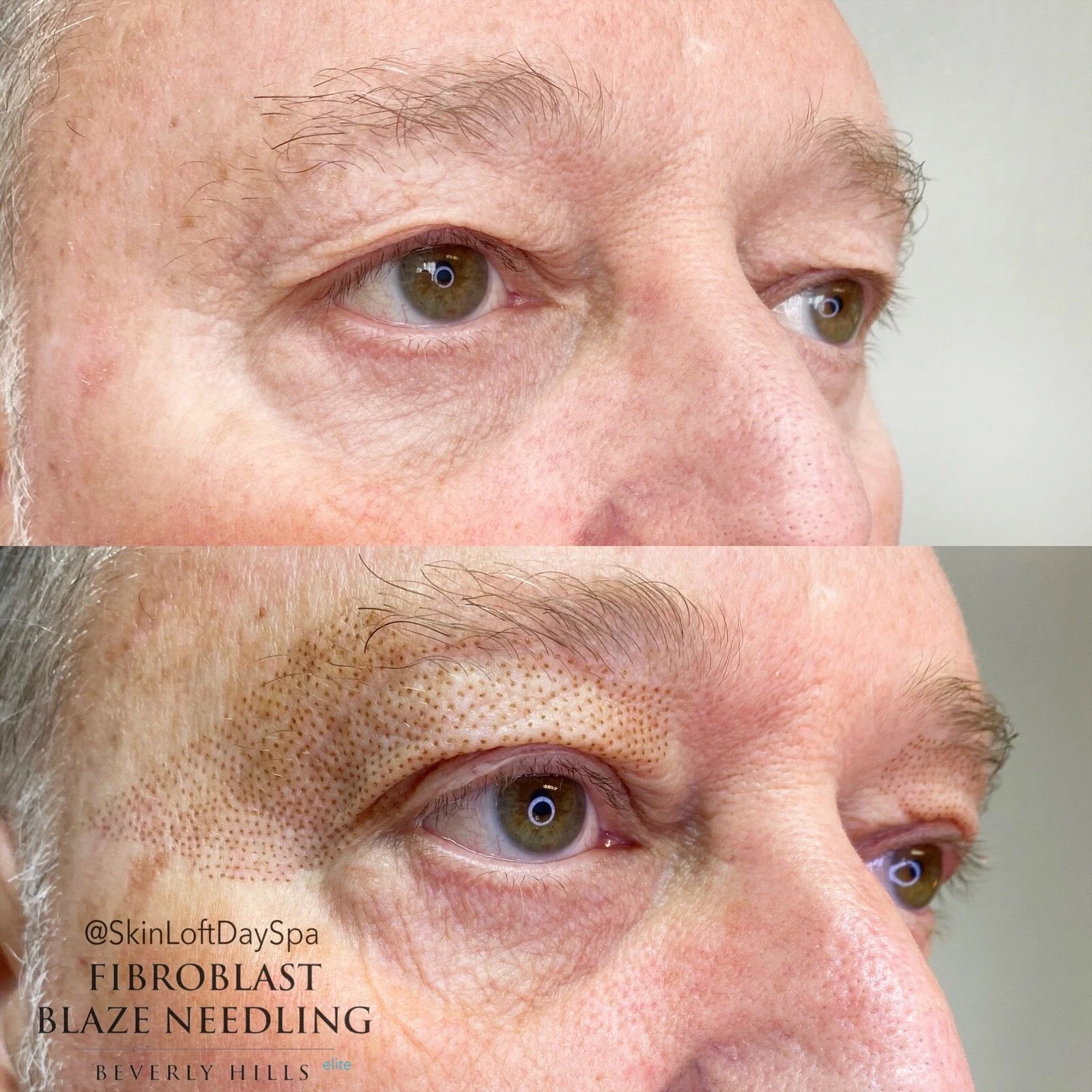plasma skin tightening