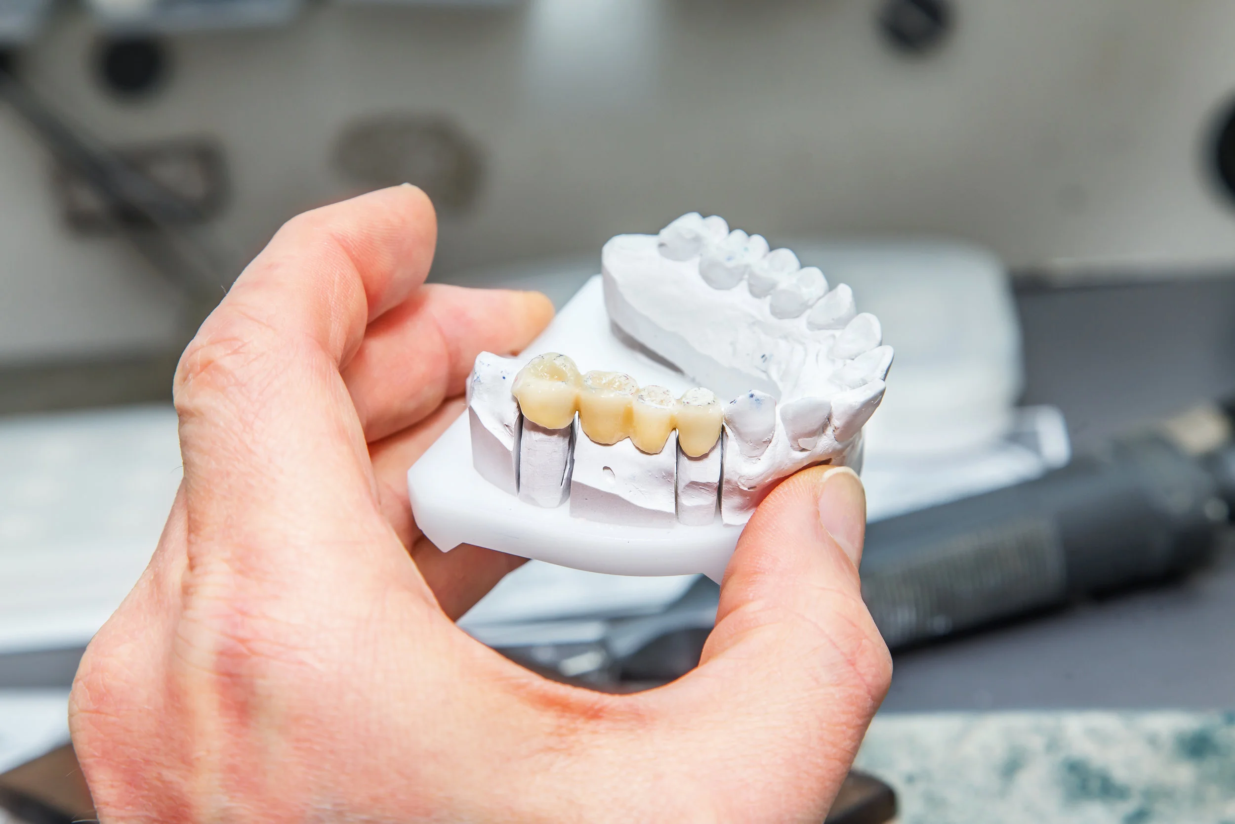 dental_bridge.jpeg