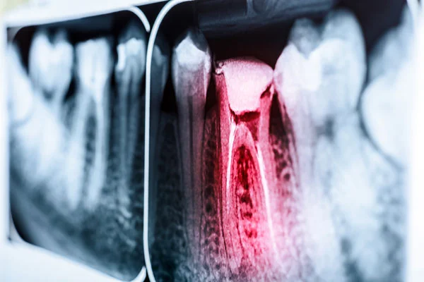 root-canal-causes.jpg