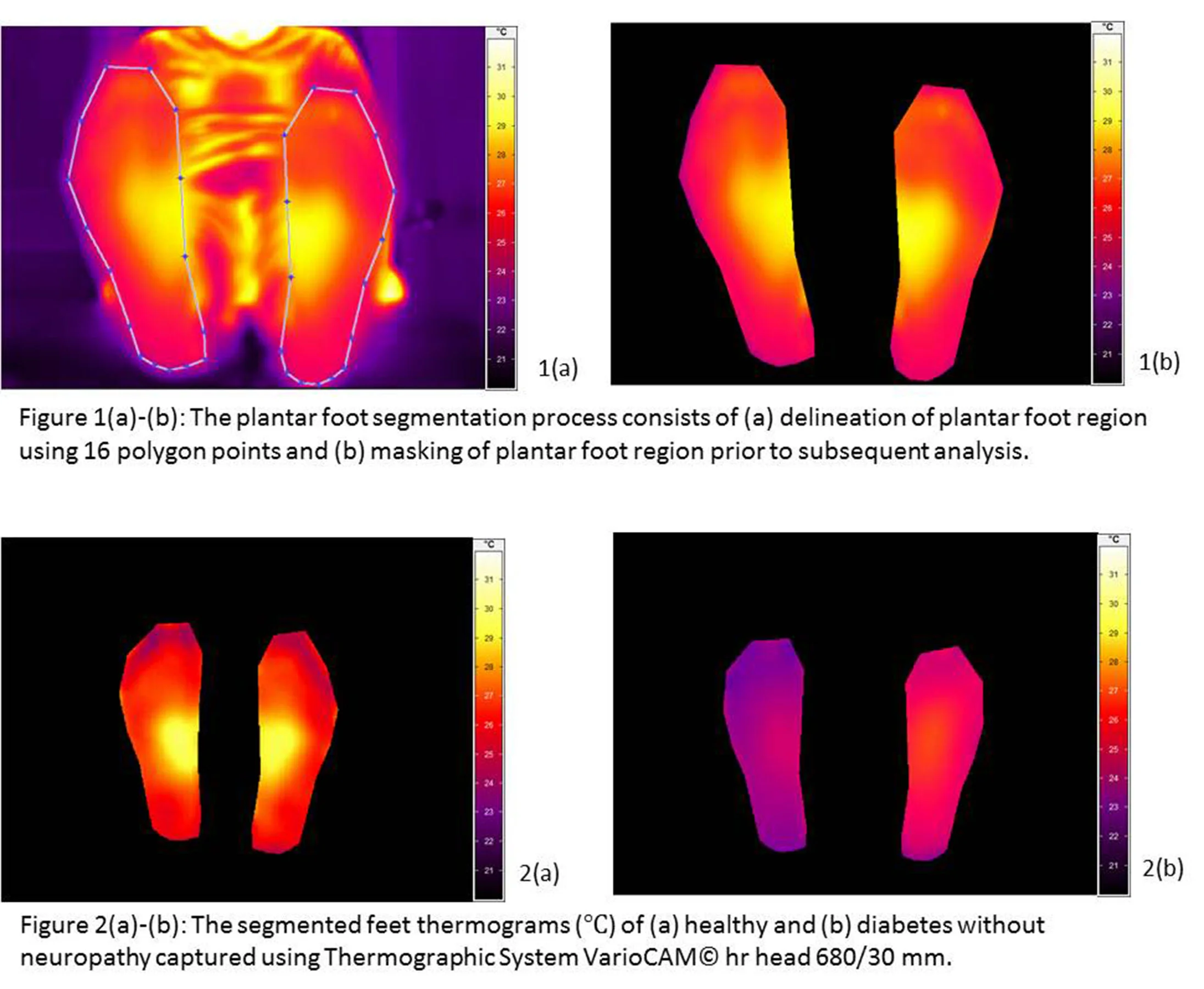 Diabetic Foot Thermograpghy.jpg