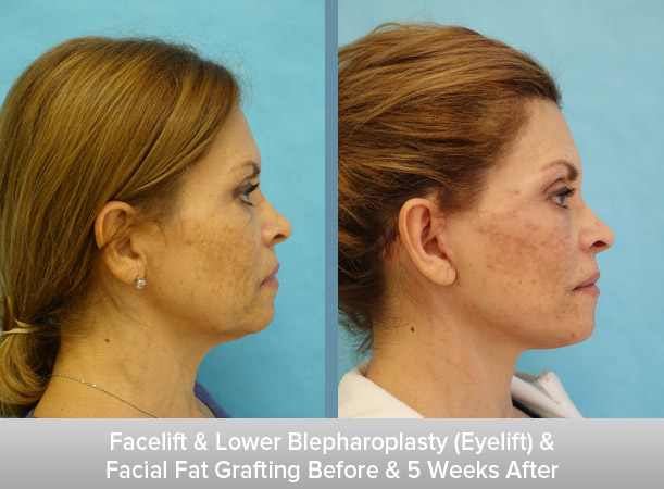 Facelift-+-Lower-Blepharoplasty-(Eyelift)-+-Facial-Fat-Grafting-5-Weeks-After-2.jpg