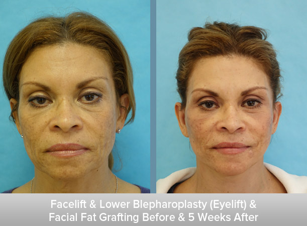 Facelift-+-Lower-Blepharoplasty-(Eyelift)-+-Facial-Fat-Grafting-5-Weeks-After.jpg