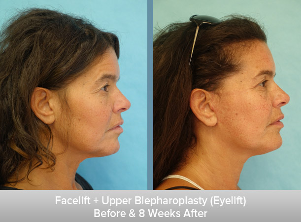 Facelift-+-Upper-Blepharoplasty-(Eyelift)-8-Weeks-After-2.jpg