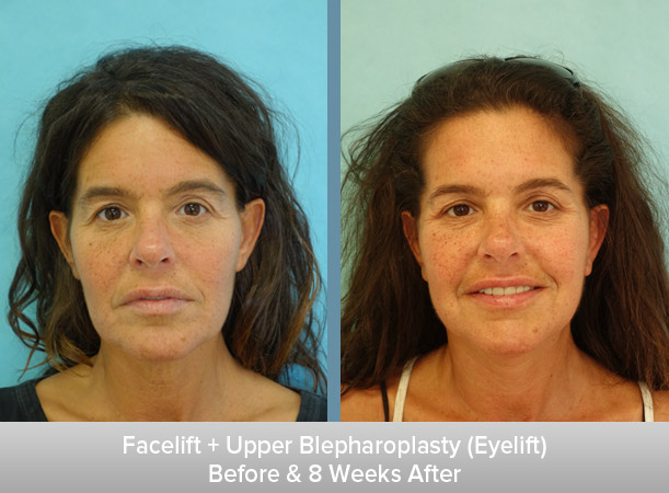 Facelift-+-Upper-Blepharoplasty-(Eyelift)-8-Weeks-After.jpg