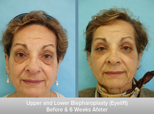 Upper-and-Lower-Blepharoplasty-(Eyelift)-6-Weeks.jpg