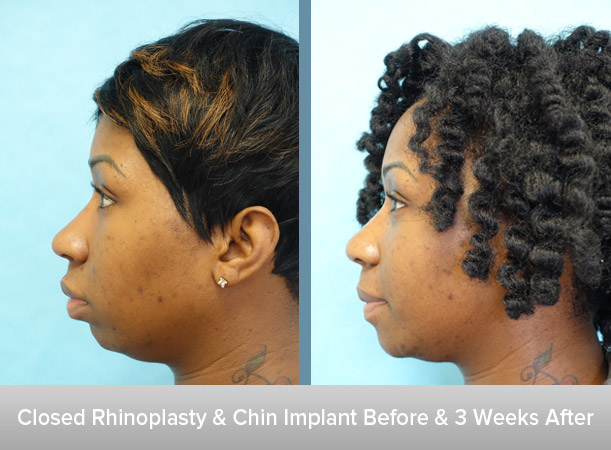 Closed-Rhinoplasty-+-Chin-Implant-2.jpg