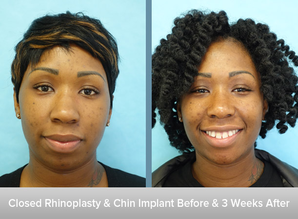 Closed-Rhinoplasty-+-Chin-Implant.jpg