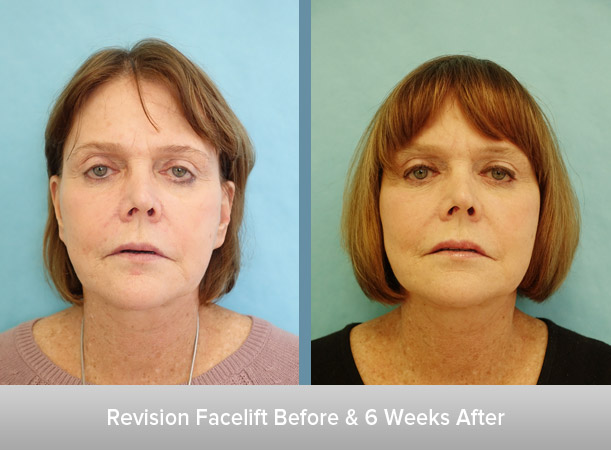 Revision-Facelift-and-After.jpg