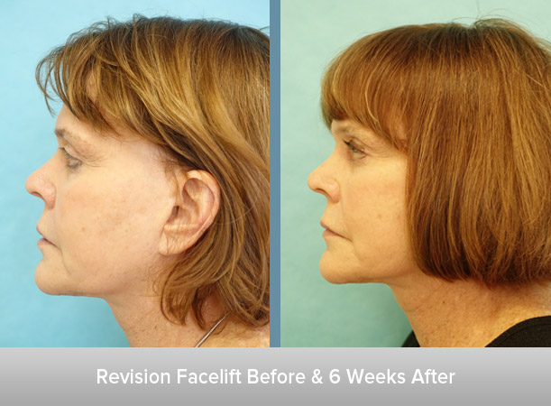Revision-Facelift-and-After-2.jpg