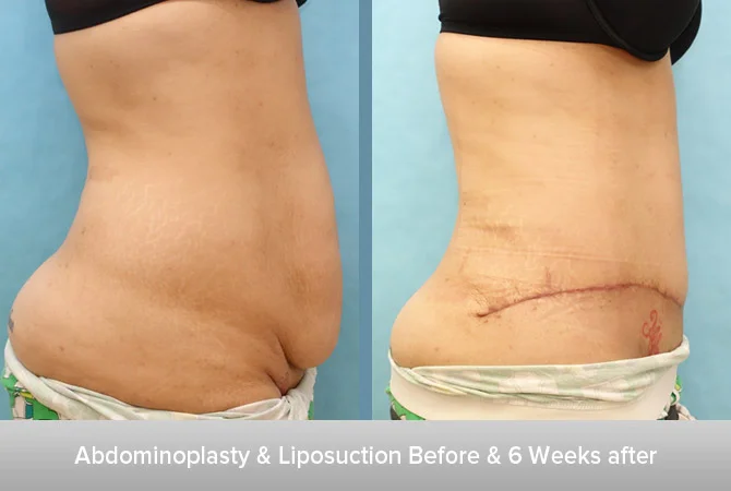 Abdominoplasty-+-Liposuction-6-6-Weeks-after.jpg