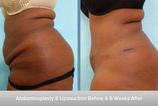 Abdominoplasty-+-Liposuction-5-6-Weeks-After.jpg