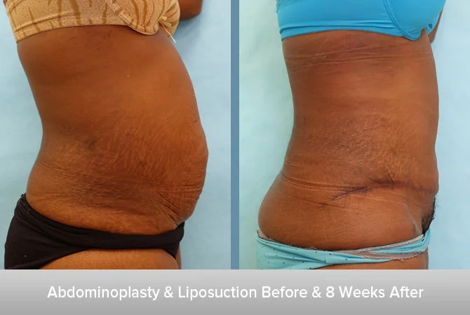 Abdominoplasty-+-Liposuction-4-8-weeks-After-2.jpg