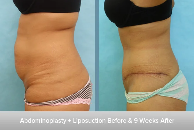 Abdominoplasty-+-Liposuction-3-9-Weeks-After-2.jpg