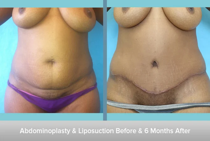 Abdominoplasty-+-Liposuction-2-6-Months-After-2.jpg