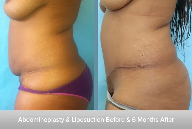 Abdominoplasty-+-Liposuction-2-6-Months-After.jpg