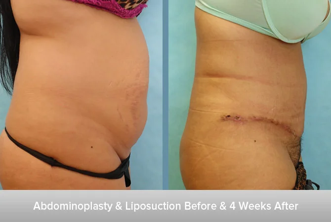 Abdominoplasty-&-Liposuction-Before-&-4-Weeks-After-2.jpg
