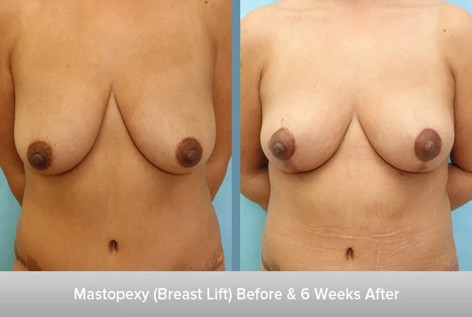 Mastopexy-6-Weeks-After-2.jpg