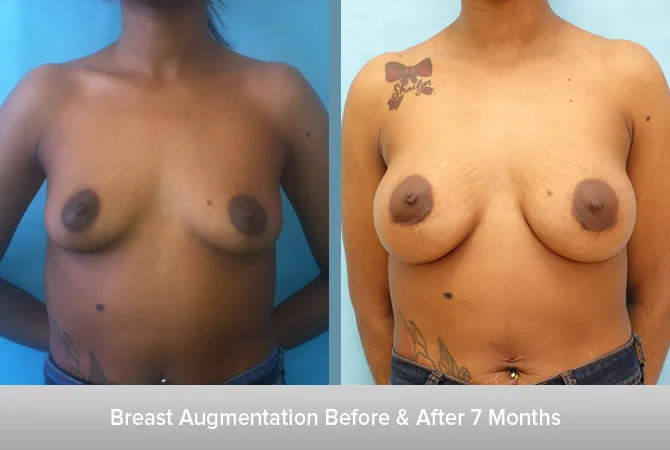 Breast-Augmentation-7-Months.jpg