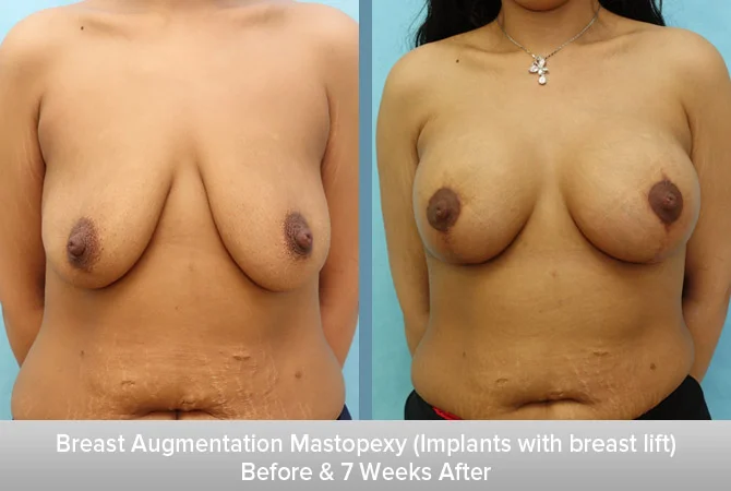 Breast-Augmentation-Mastopexy-(Implants-with-breast-lift).jpg