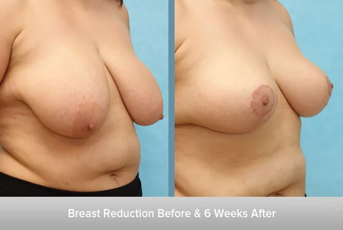 Breast-Reduction-6-Weeks-After.jpg
