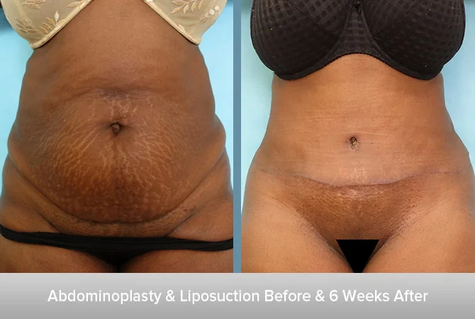 Abdominoplasty-+-Liposuction-5-6-Weeks-After-2.jpg