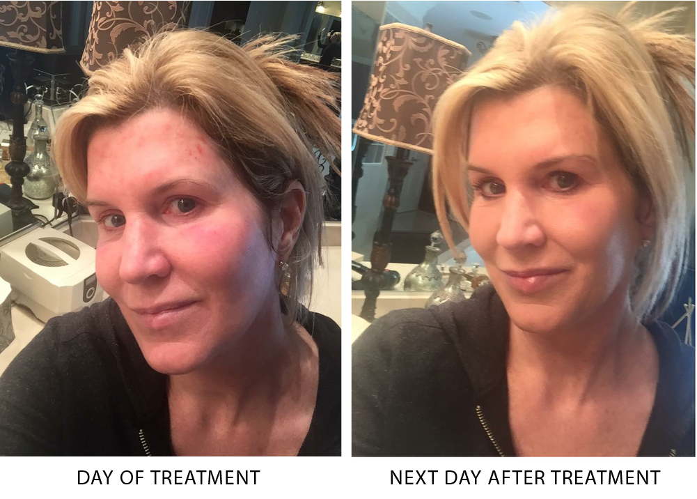 norah-microneedling.png