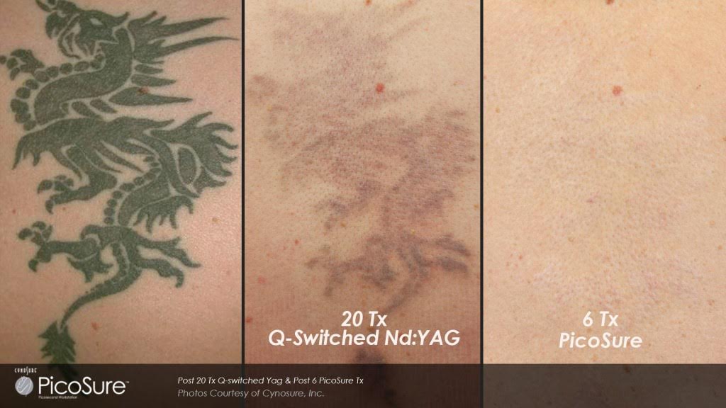 Laser Tattoo Removal You Can Be Sure Of with PicoSure — Norah Clair  Aesthetics