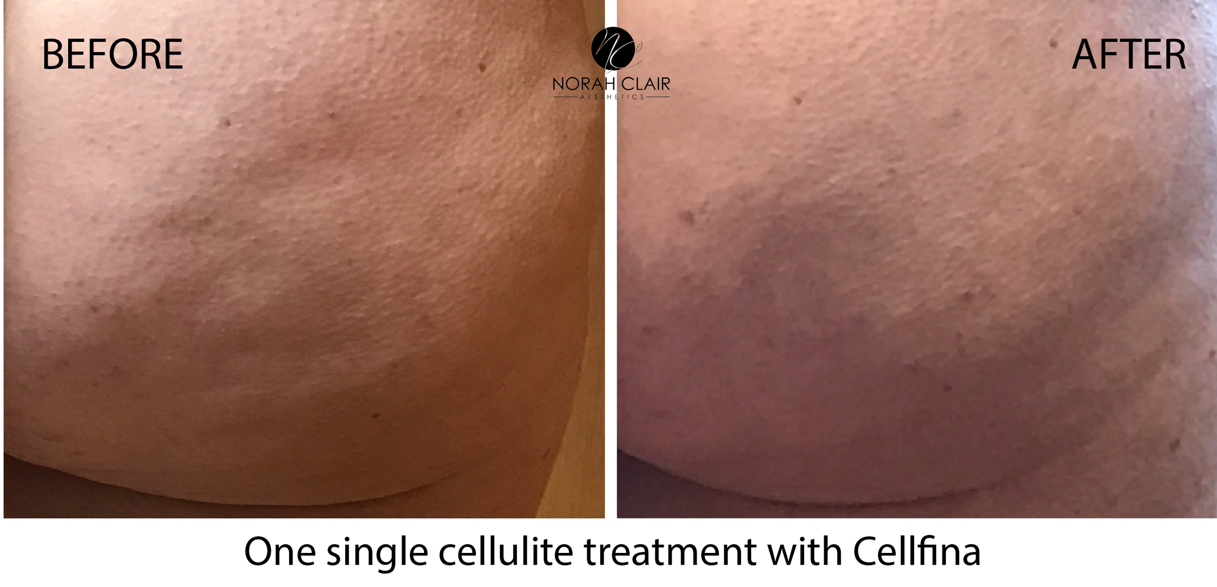 Cellfina® - Cellulite Treatment