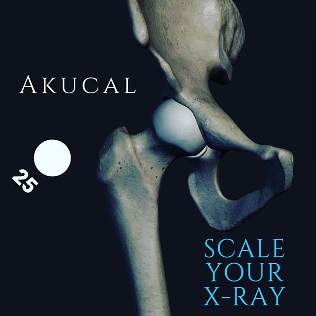 If being accurate with your measurments for planning surgical procedures is of any importance to you... then you should probably Akucal. Buy direct.
#xraygraffiti #haveanicexray
#orthopedicsurgery #surgeon #surgeonlife #orthopedic #orthopeadic #magnification #magfactor #veterinarysurgery #orhopedicsoftware #xray #xrayscaling #j2marker #akucal #j2medical #magmarker #3dprint #hipreplacement #jointreplacement #medical #orthoclinic #radiography #xraymagnification #doctor #radtech #radiology #radiologylife #jarridhenderson