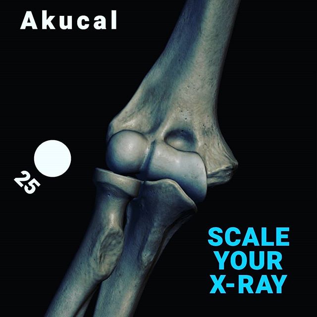 How do you know the mag factor if you don't use an Akucal? 
#xraygraffiti #haveanicexray
#orthopedicsurgery #surgeon #surgeonlife #orthopedic #orthopeadic #magnification #magfactor #veterinarysurgery #orhopedicsoftware #xray #xrayscaling #j2marker #a